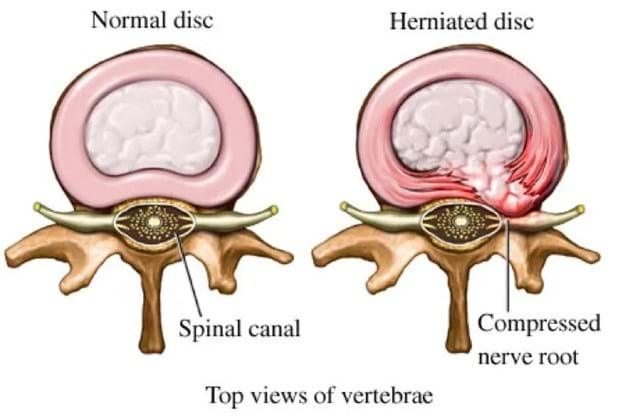 What Are Lumbar Disc Injuries