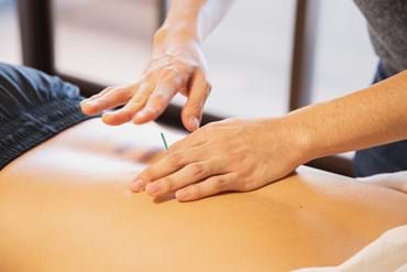 Dry Needling Therapy, Essendon Physio Group, Melbourne