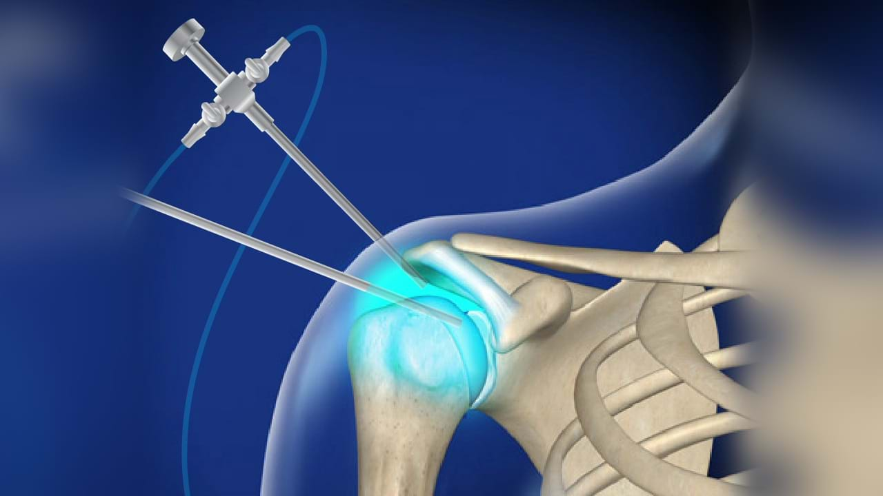 What Is A Shoulder Arthroscopy