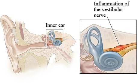 What is a Vestibular Disorder? Can Physio Help?
